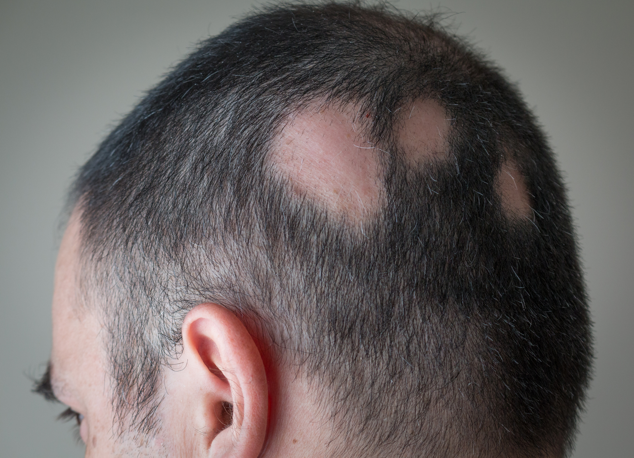 Sudden Hair Loss Can Happen To Anyone - Health Beat