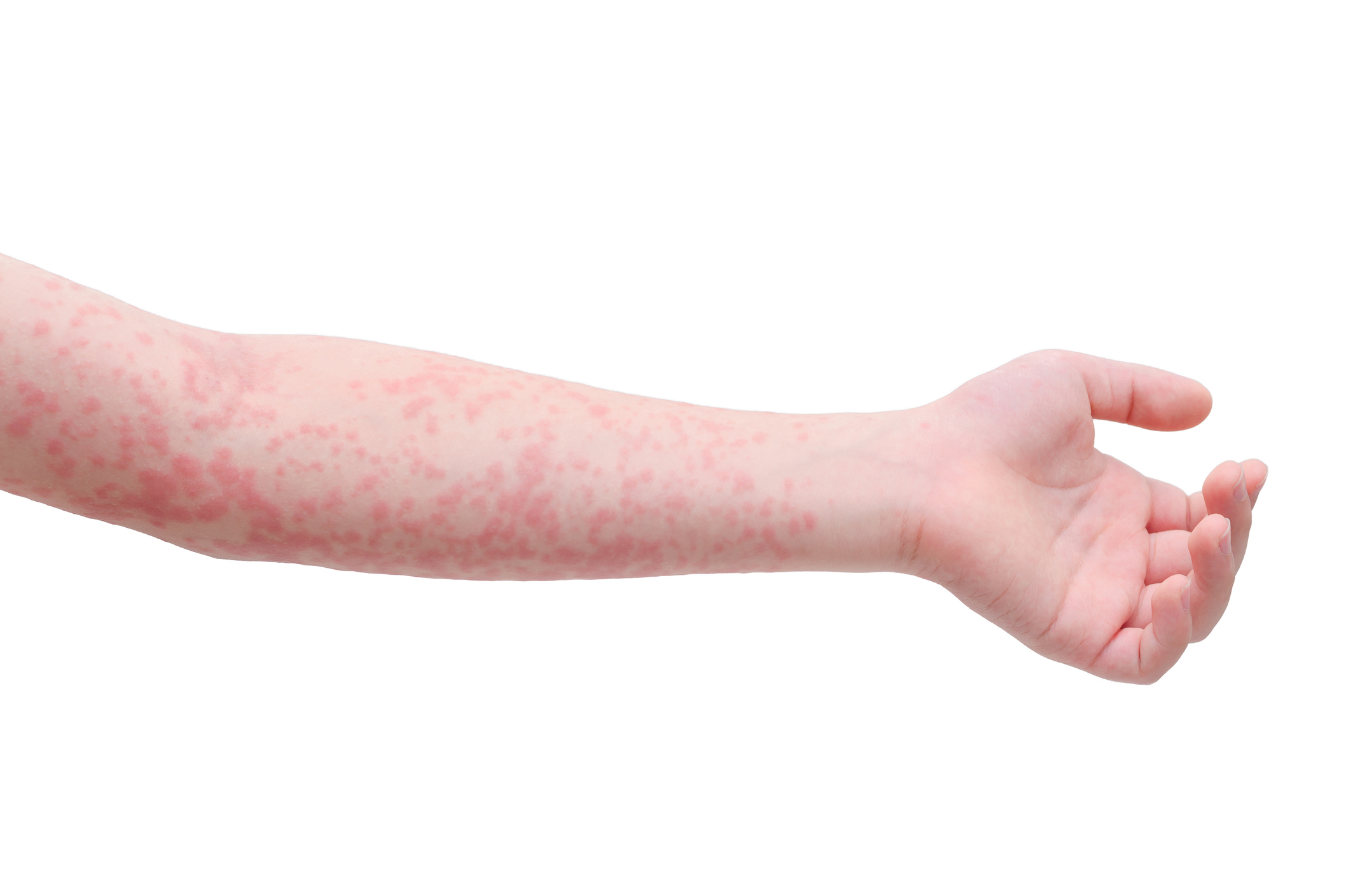 Scarlet fever rash: Symptoms, diagnosis, and treatment