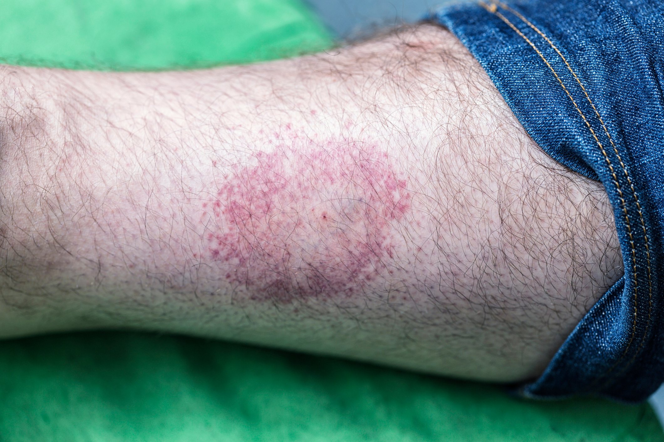 Signs and Symptoms of Untreated Lyme Disease - Health Beat