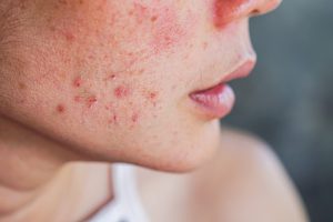 An outbreak of hormonal acne on a woman's cheek.